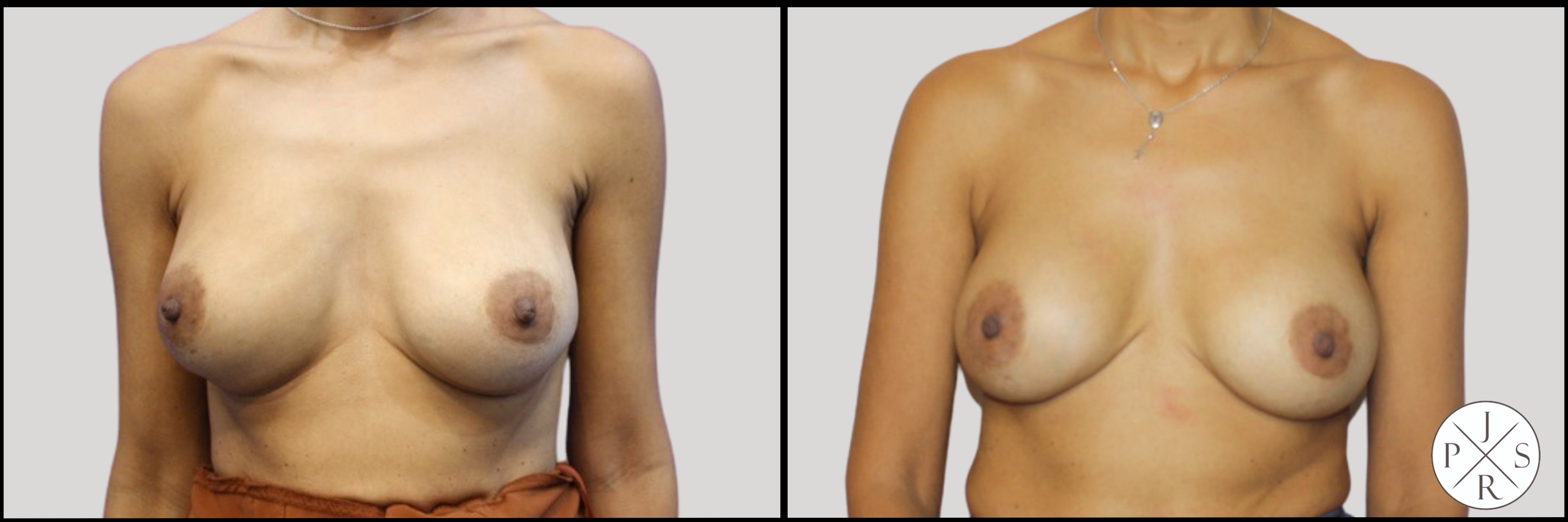 Breast Revision Before & After Image